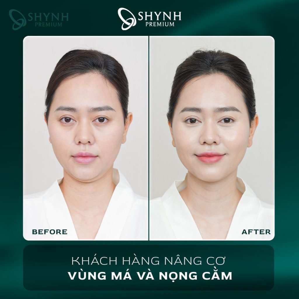 Hình ảnh khách hàng trước và sau liệu trình của Shynh Premium
