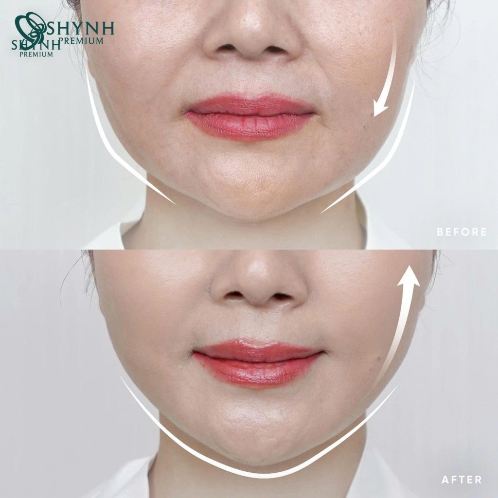 Sự thay đổi của khách hàng sau liệu pháp nâng cơ công nghệ cao Shynh Ultherapy Prime