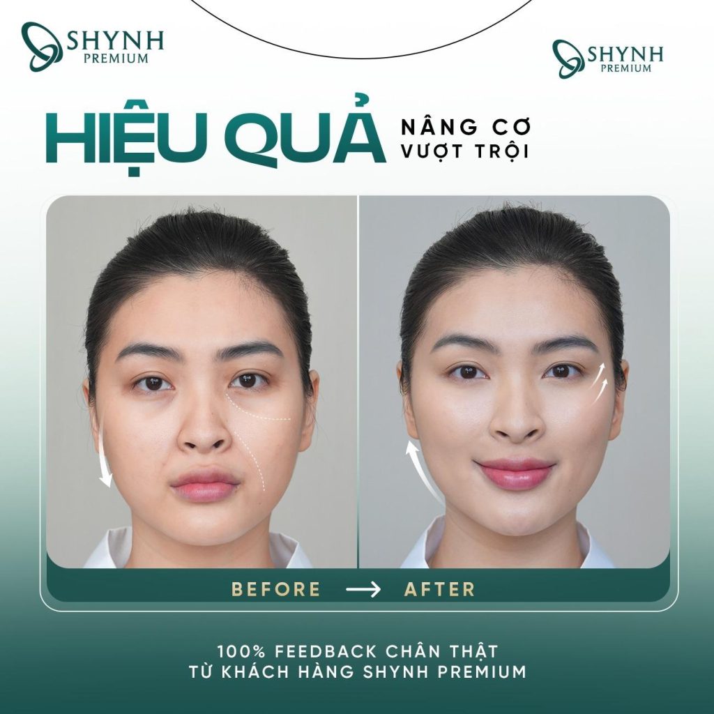 Các liệu pháp nâng cơ, trẻ hoá da mặt tại Shynh Premium mang lại hiệu quả vượt trội