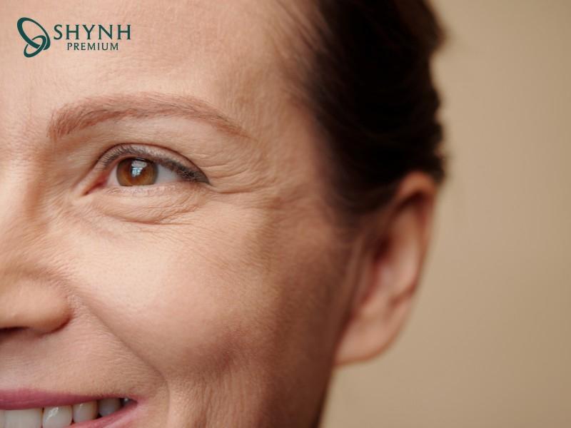 Nếp nhăn khoé miệng xuất hiện từ sự kết hợp của nhiều yếu tố nội tại và lối sống