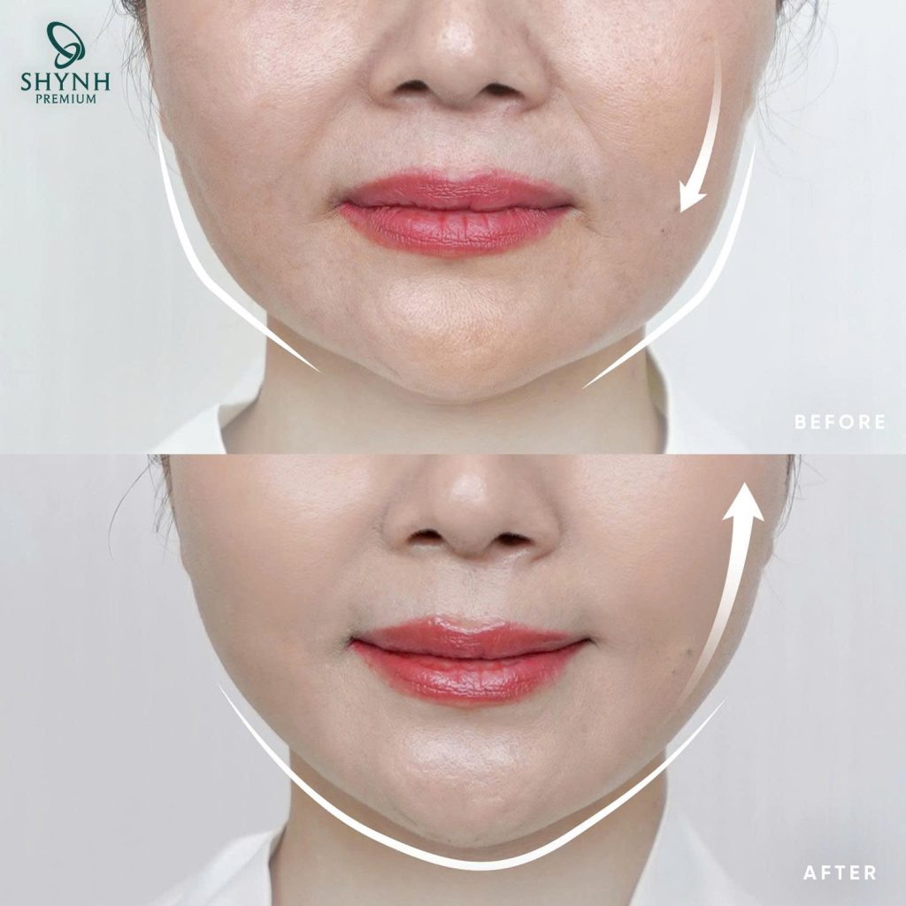 Căng da mặt thường phù hợp nhất từ khoảng 40–60 tuổi hoặc khi da xuất hiện dấu vết lão hoá