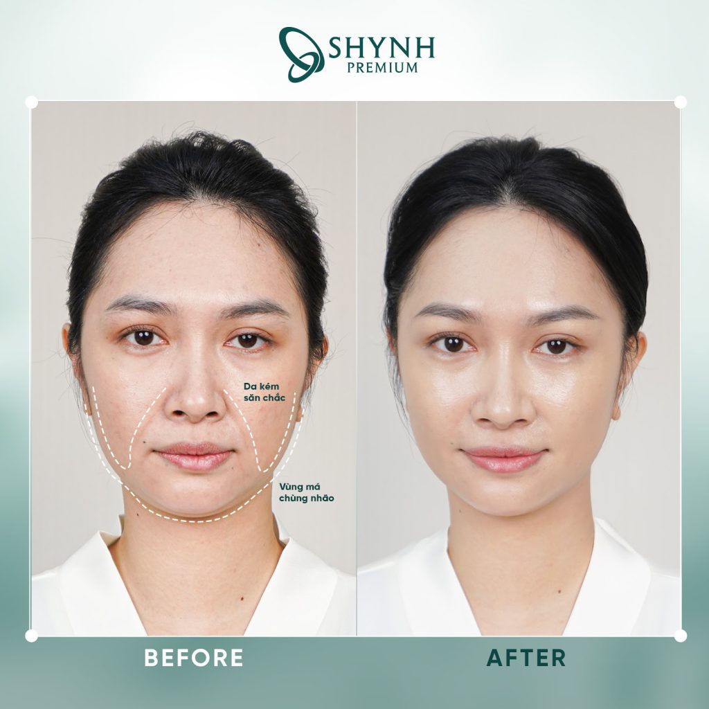 Để hạn chế tối đa rủi ro và đảm bảo kết quả như mong muốn, hãy lưu ý chuẩn bị đúng trước trong và sau khi điều trị