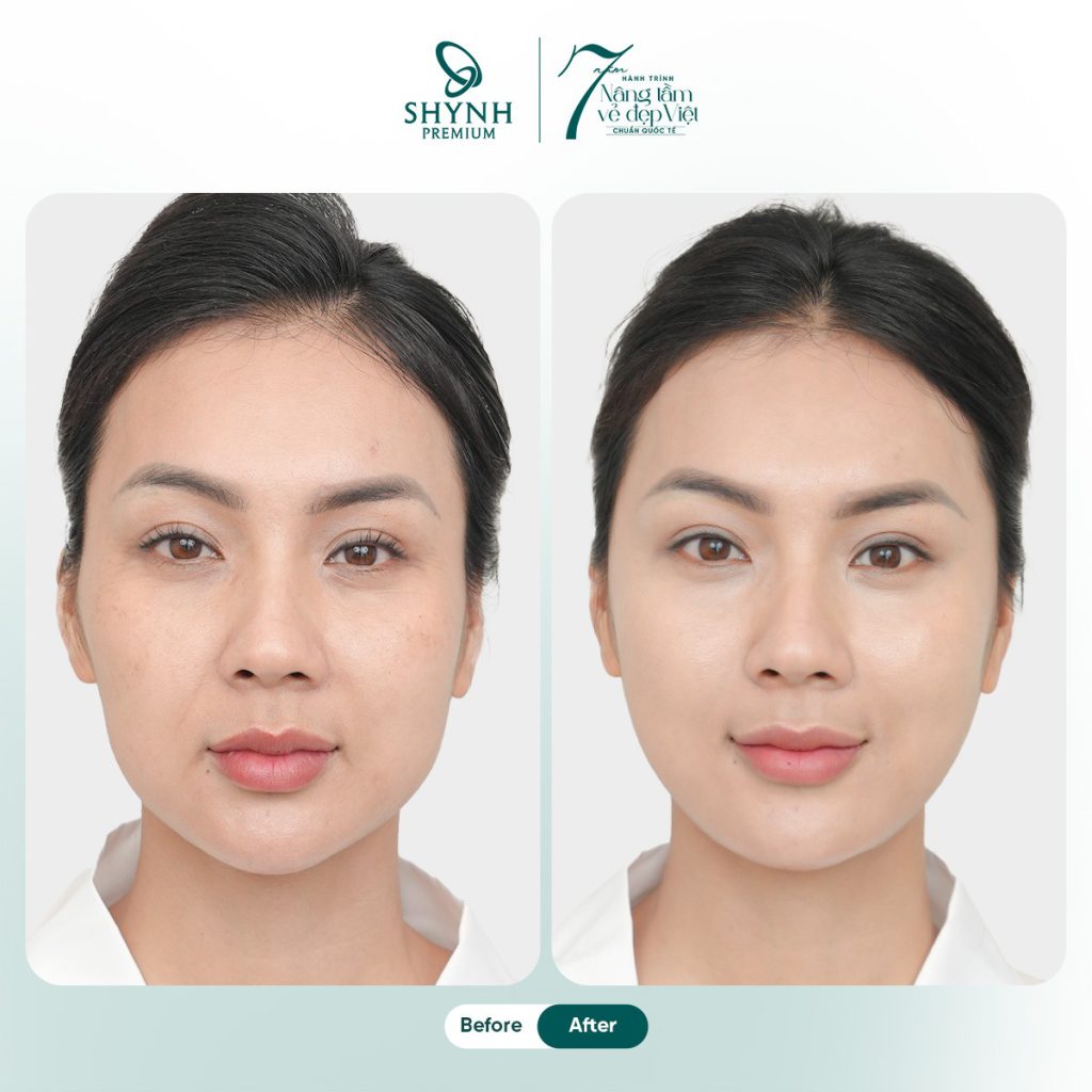 Hình ảnh khách hàng sau khi căng chỉ da mặt tại Shynh Premium