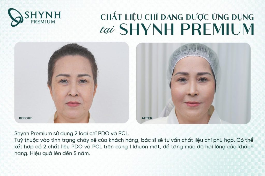Tại Shynh Premium, các liệu pháp căng da bằng chỉ được xây dựng theo tiêu chuẩn y khoa quốc tế