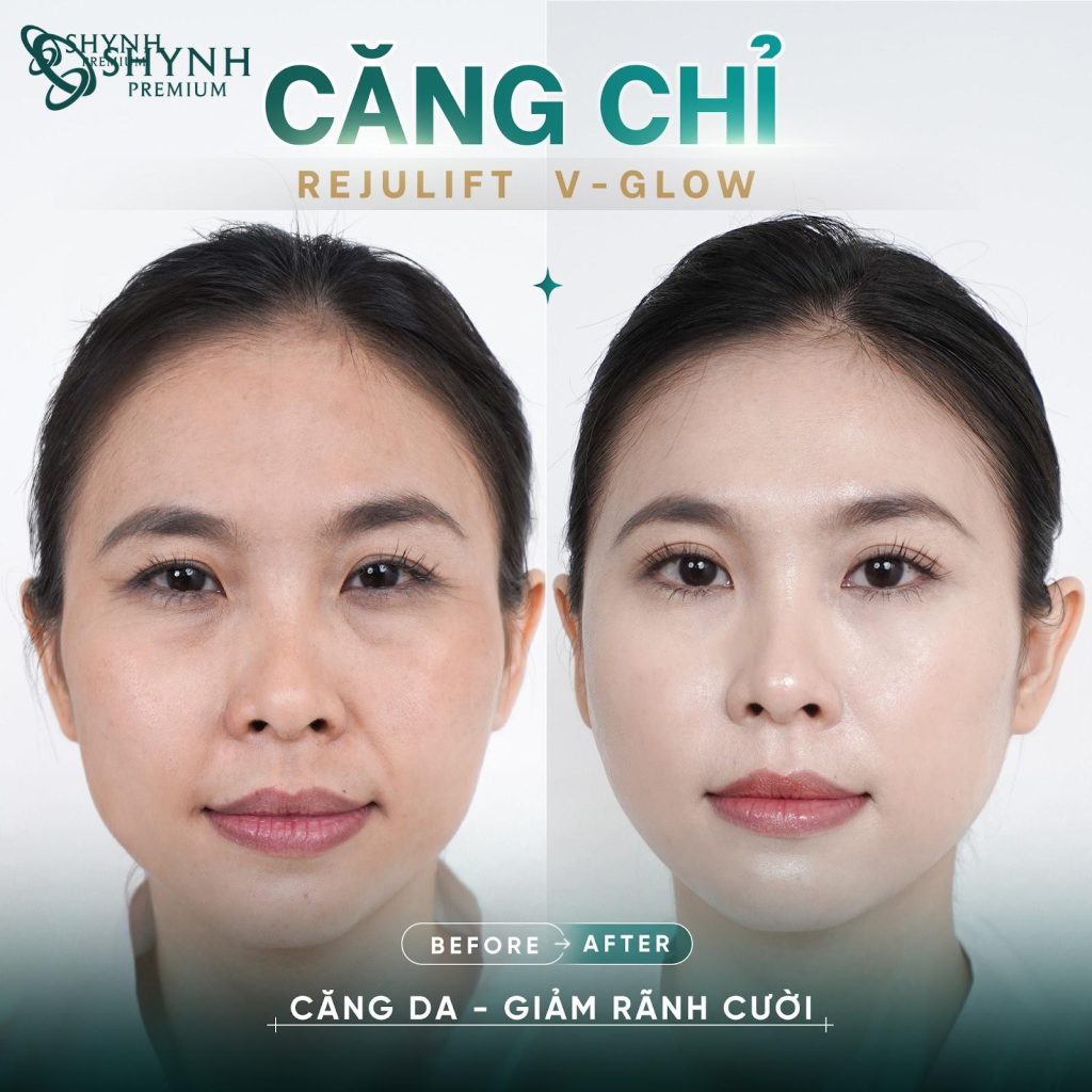Hình ảnh khách hàng sau khi thực hiện liệu trình căng chỉ tại Shynh Premium