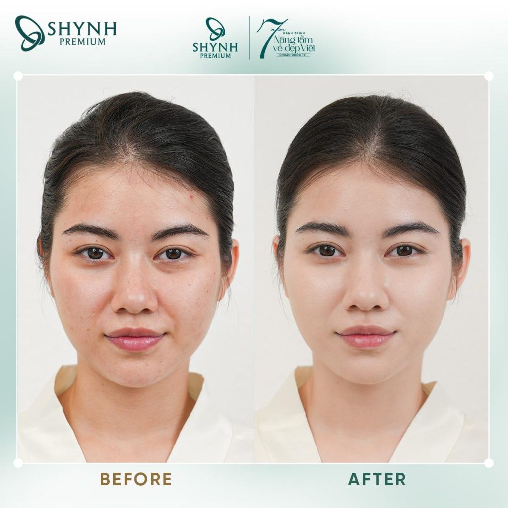 Tại Shynh Premium, khách hàng được hướng dẫn kỹ càng về chăm sóc sau khi căng chỉ