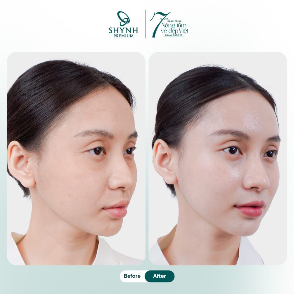 Căng da mặt 3D là gì? Căng da mặt 3D là phương pháp trẻ hoá không phẫu thuật tác động đa tầng