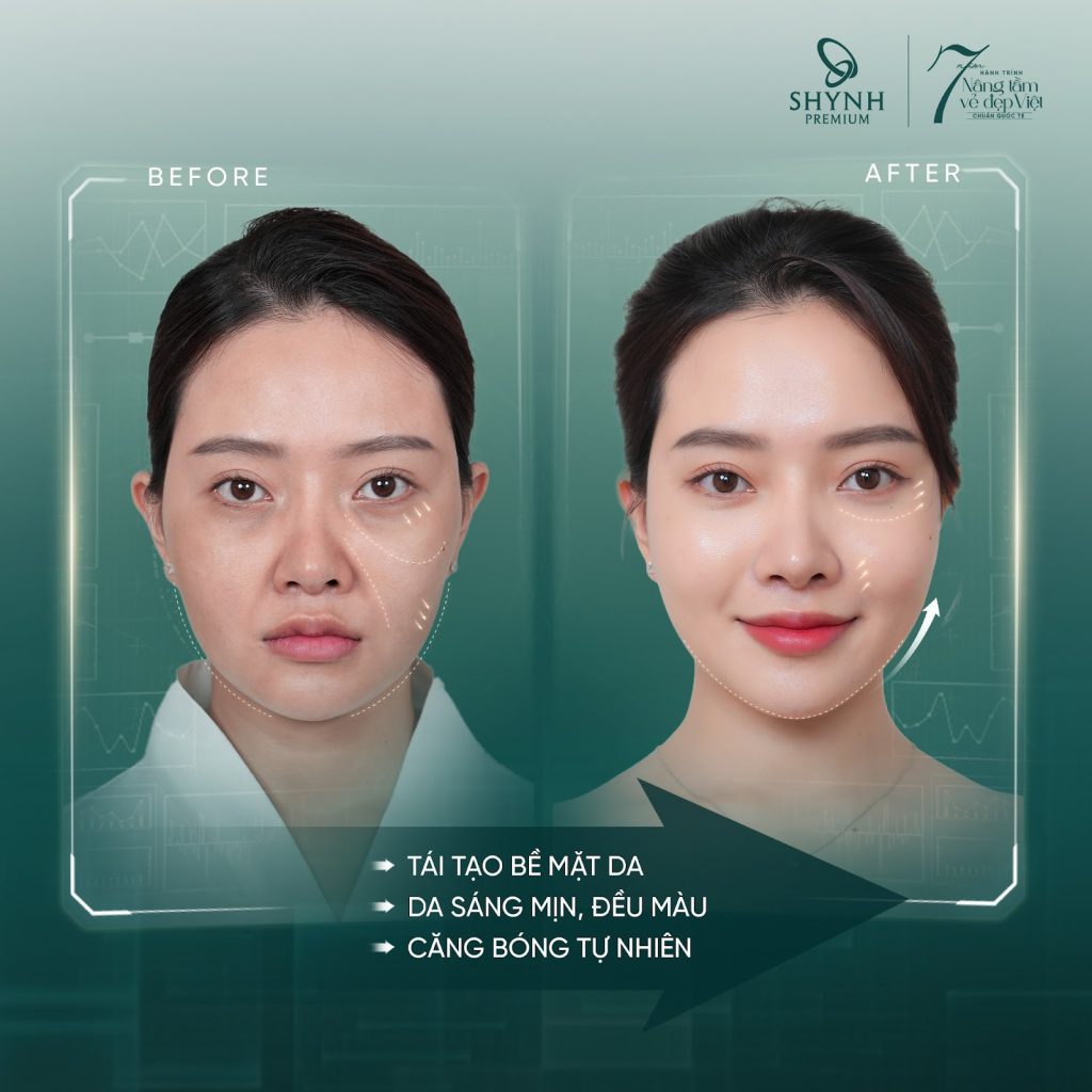 Sau khi thực hiện căng da mặt, khách hàng sẽ thấy ngay kết quả và hiệu quả càng rõ rệt hơn theo thời gian