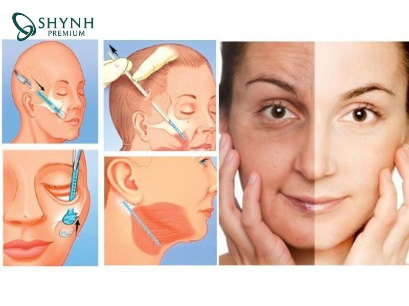 Phẫu thuật căng da mặt cần được thực hiện tại cơ sở uy tín và bác sĩ tay nghề cao để tránh biến chứng