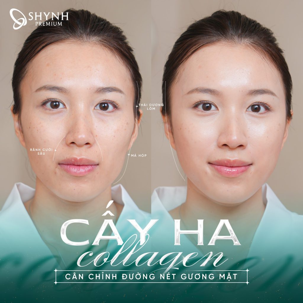 Căng chỉ collagen là phương pháp căng da mặt không phẫu thuật được ưa chuộng