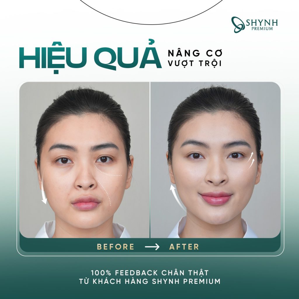 Căng chỉ collagen phù hợp với người muốn trẻ hóa da nhẹ nhàng mà không phẫu thuật