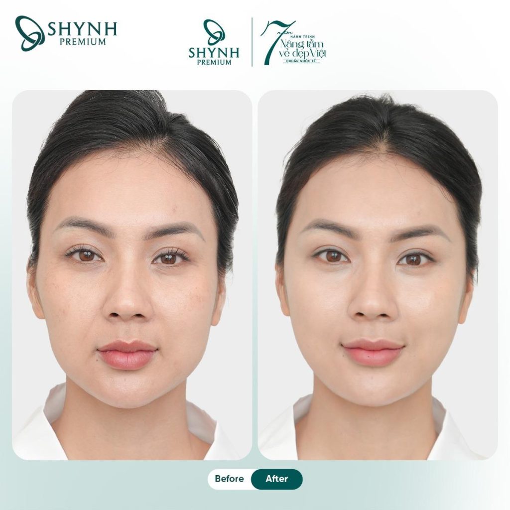Hình ảnh khách hàng sau khi thực hiện liệu trình căng da mặt tại Shynh Premium