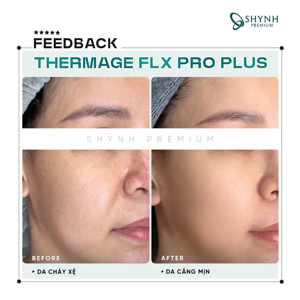 Hình ảnh feedback khách hàng khi dùng liệu pháp căng da tại Shynh Premium
