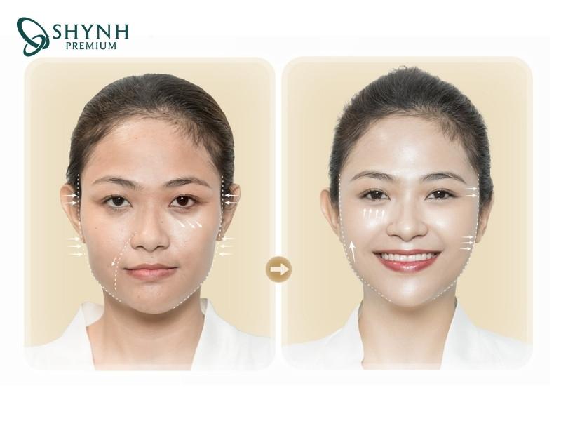 Hình ảnh khách hàng tại Shynh Premium trước và sau khi thực hiện liệu pháp cấy tế bào gốc