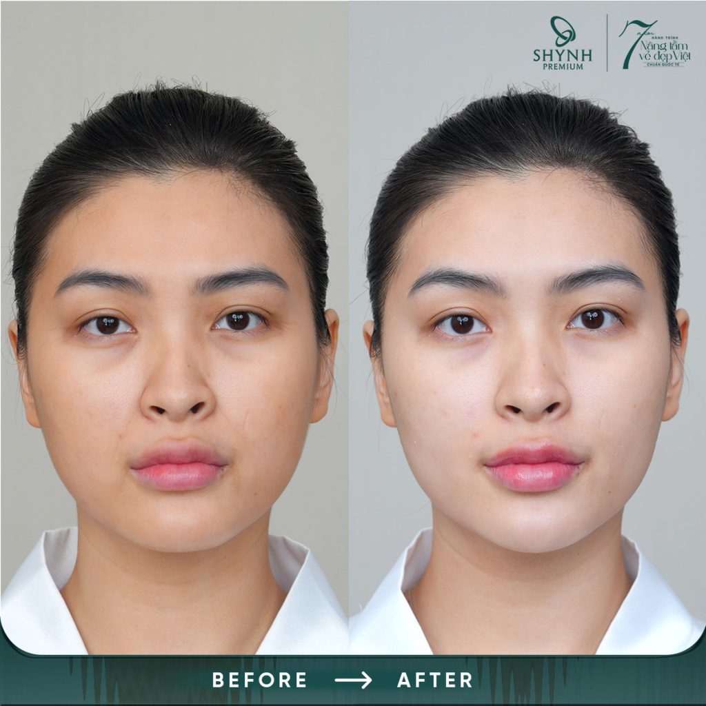 Công nghệ laser giúp tái tạo da nhanh chóng, ít xâm lấn, thời gian phục hồi nhanh