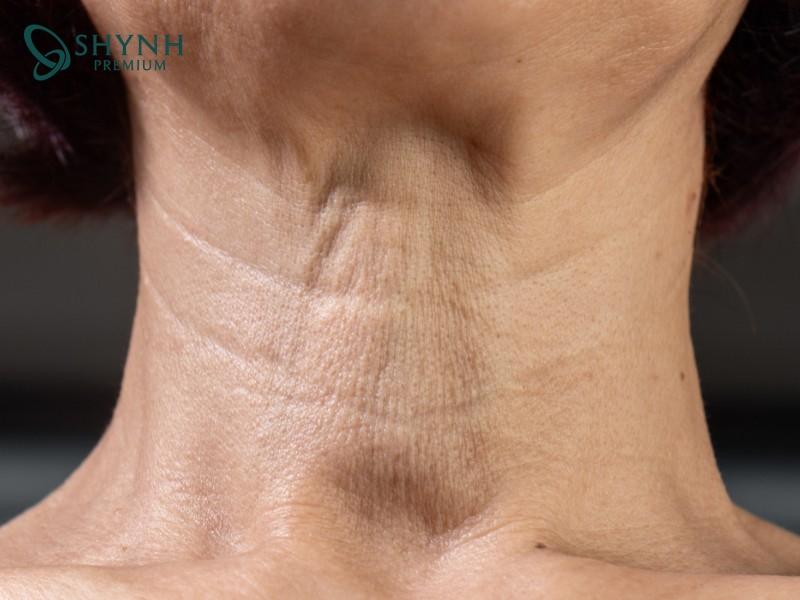 Khi bước qua tuổi 25, collagen và elastin suy giảm khiến da lão hóa nhanh