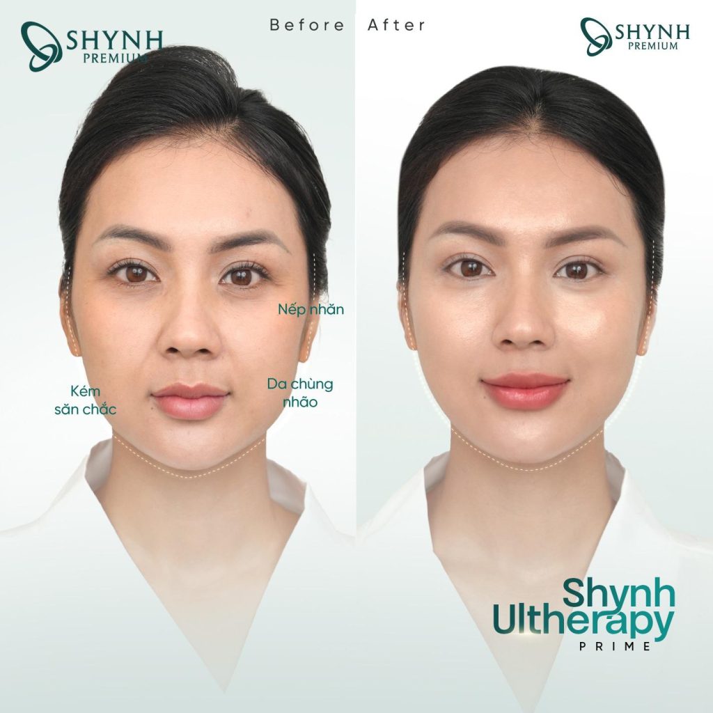 Hình ảnh trước và sau khi khách hàng dùng liệu pháp Shynh Ultherapy Prime của Shynh Premium