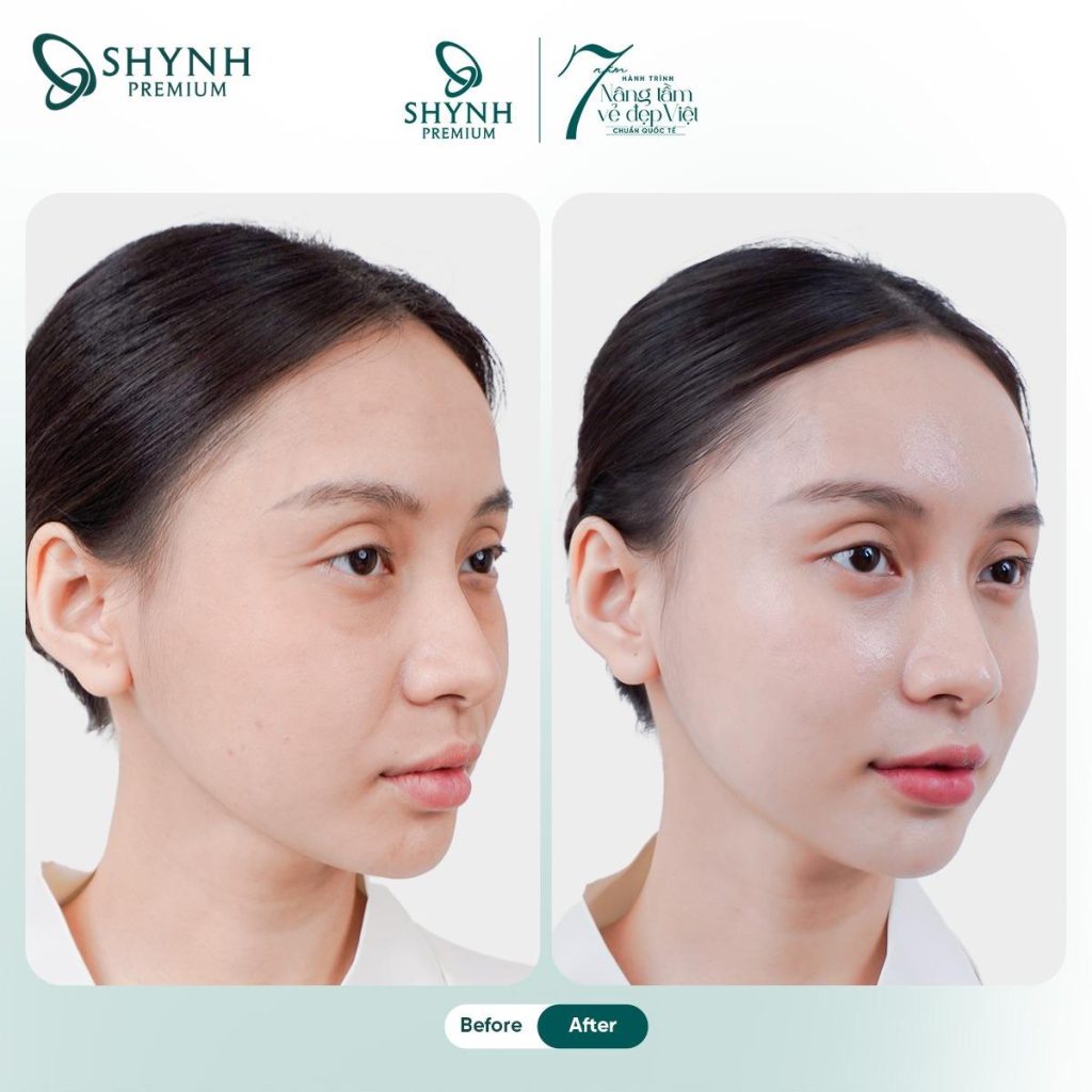 Liệu pháp căng chỉ Rejulift V-Glow tại Shynh Premium mang lại cho khách hàng diện mạo tươi trẻ