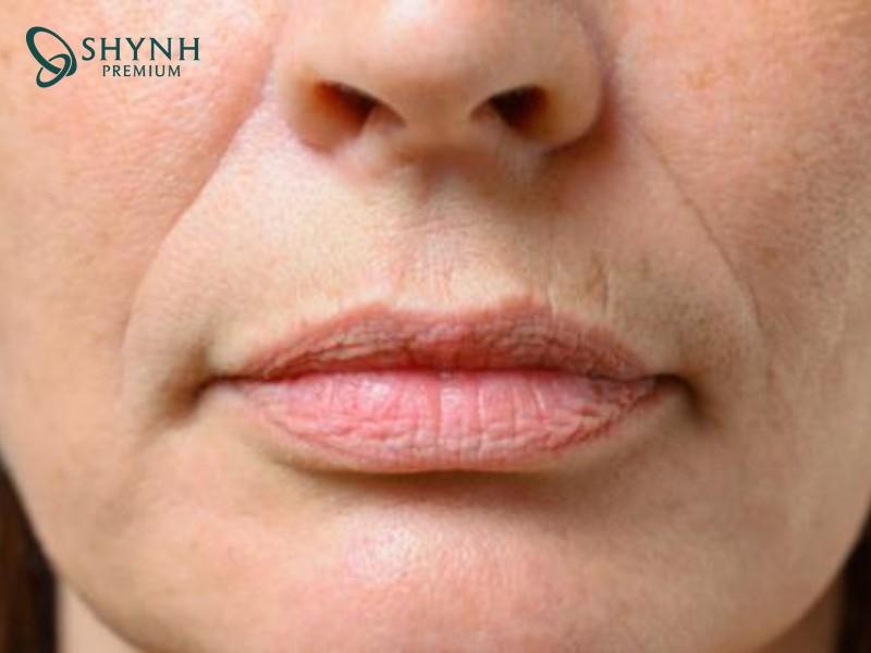 Nếp nhăn môi hình thành có thể từ nhiều yếu tố tác động, đặc biệt là lão hoá tự nhiên