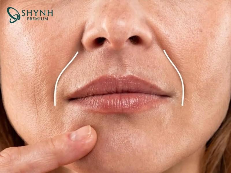 Cười, nói hoặc biểu cảm mạnh trong thời gian dài hình thành nếp nhăn rãnh cười