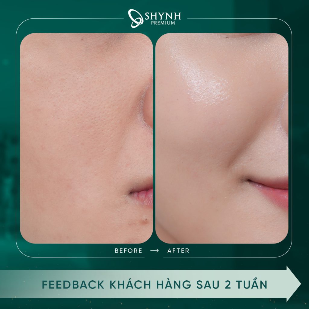 Hình ảnh trước và sau khi khách hàng thực hiện liệu trình xoá nhăn tại Shynh Premium
