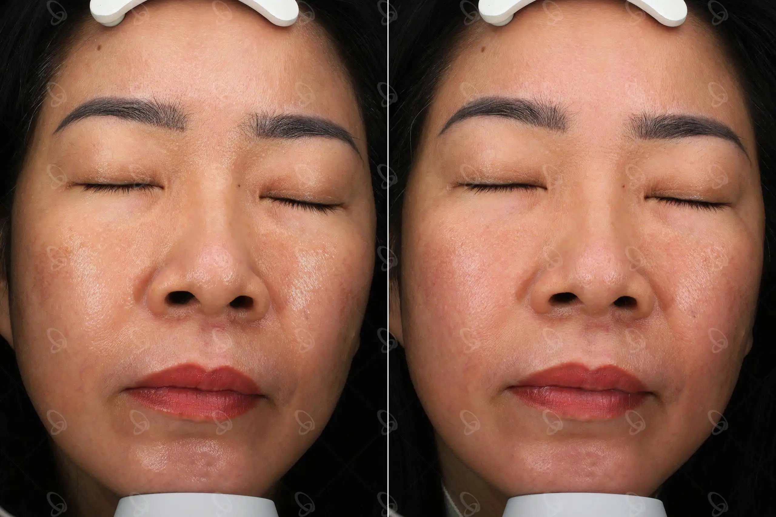 Khách hàng trị nám da phác đồ Shynh Pico Toning