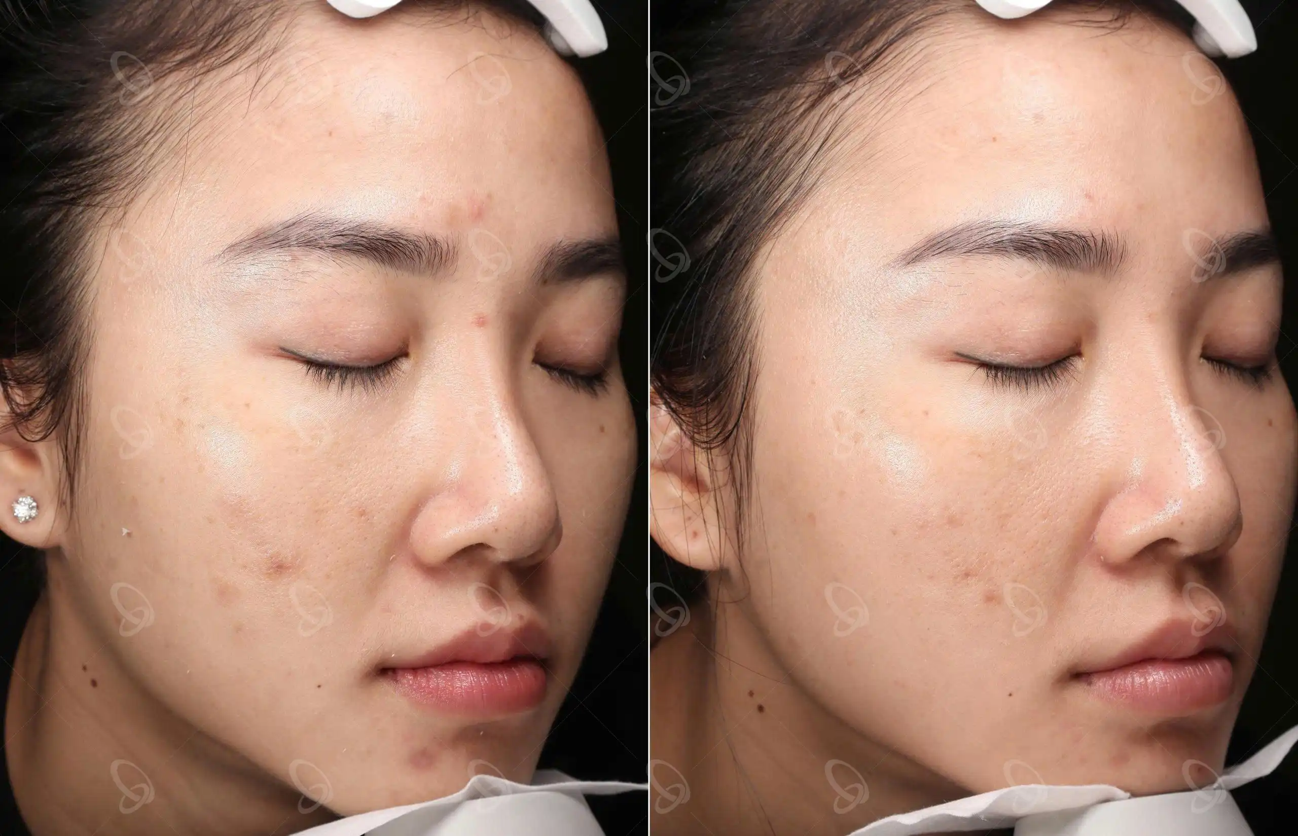 Khách hàng trị thâm mụn với Shynh Pico Toning
