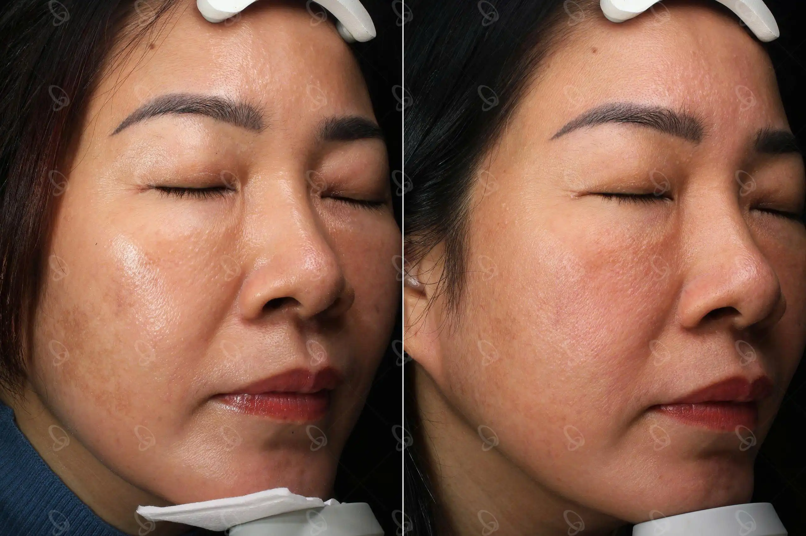 Khách hàng trẻ hóa và trị nám với Shynh Pico Toning