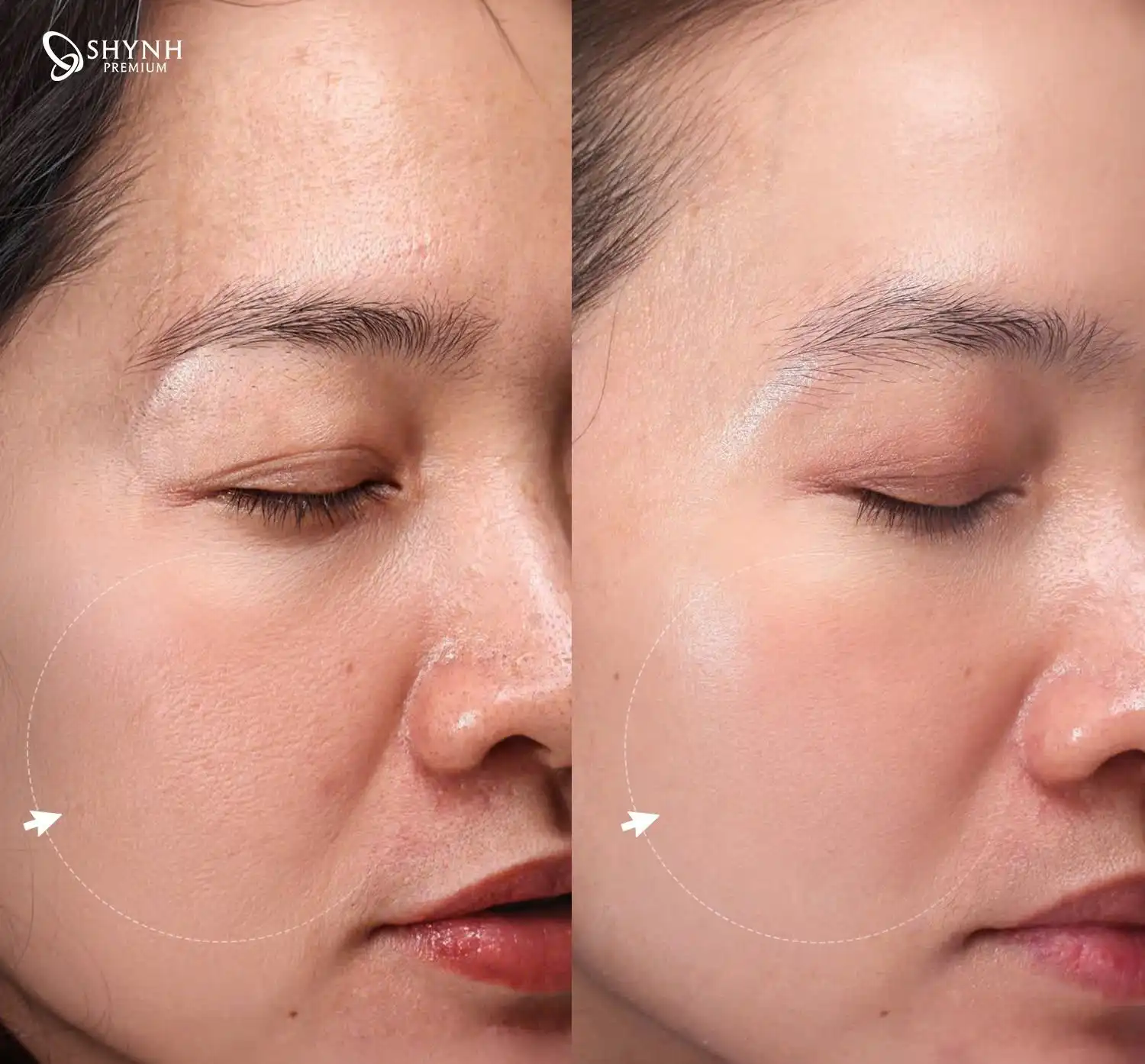 Laser AlmaQ Trẻ hóa da đa tầng & Sẹo mụn tại Shynh Premium