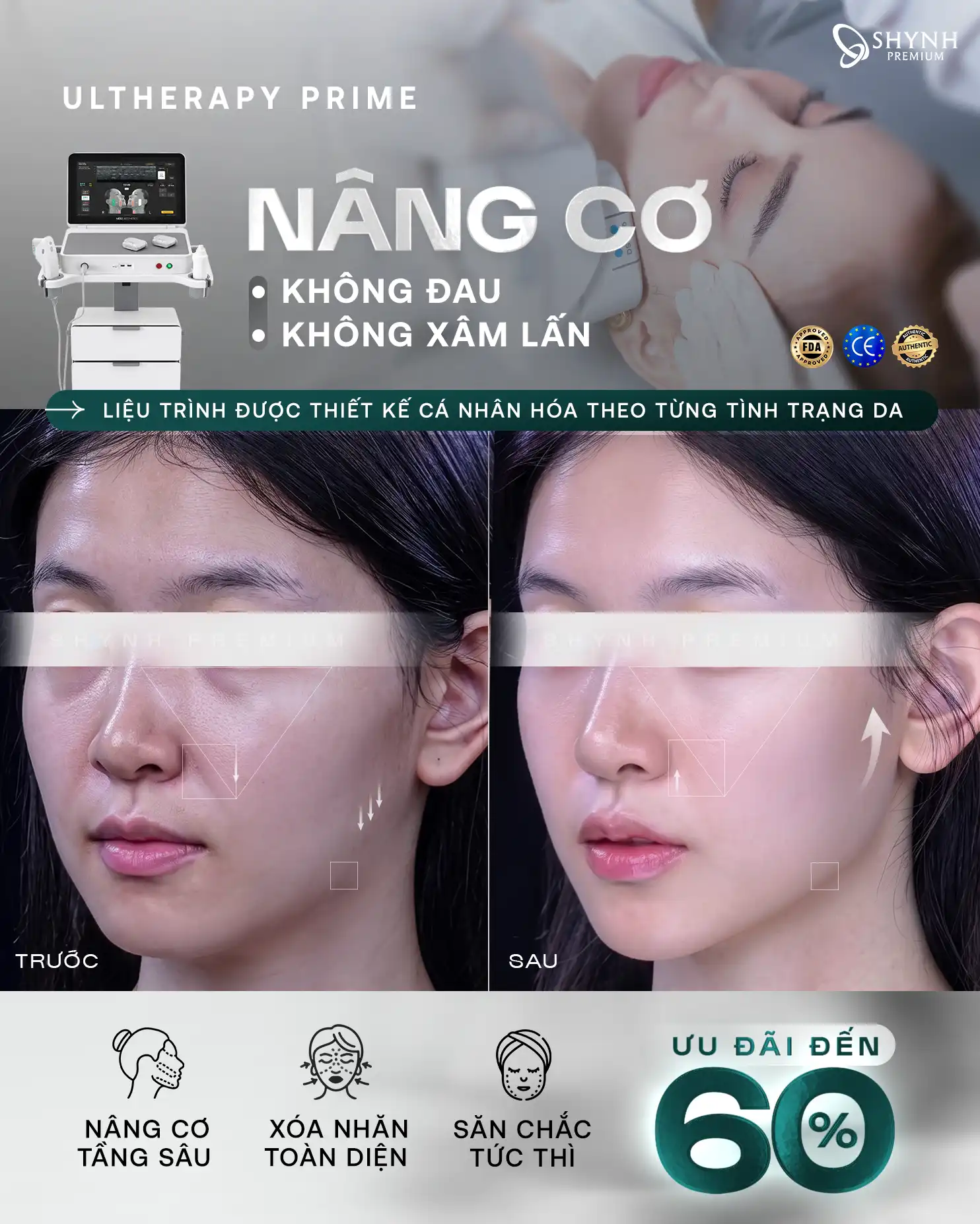 Cơ chế hoạt động của Ultherapy Prime