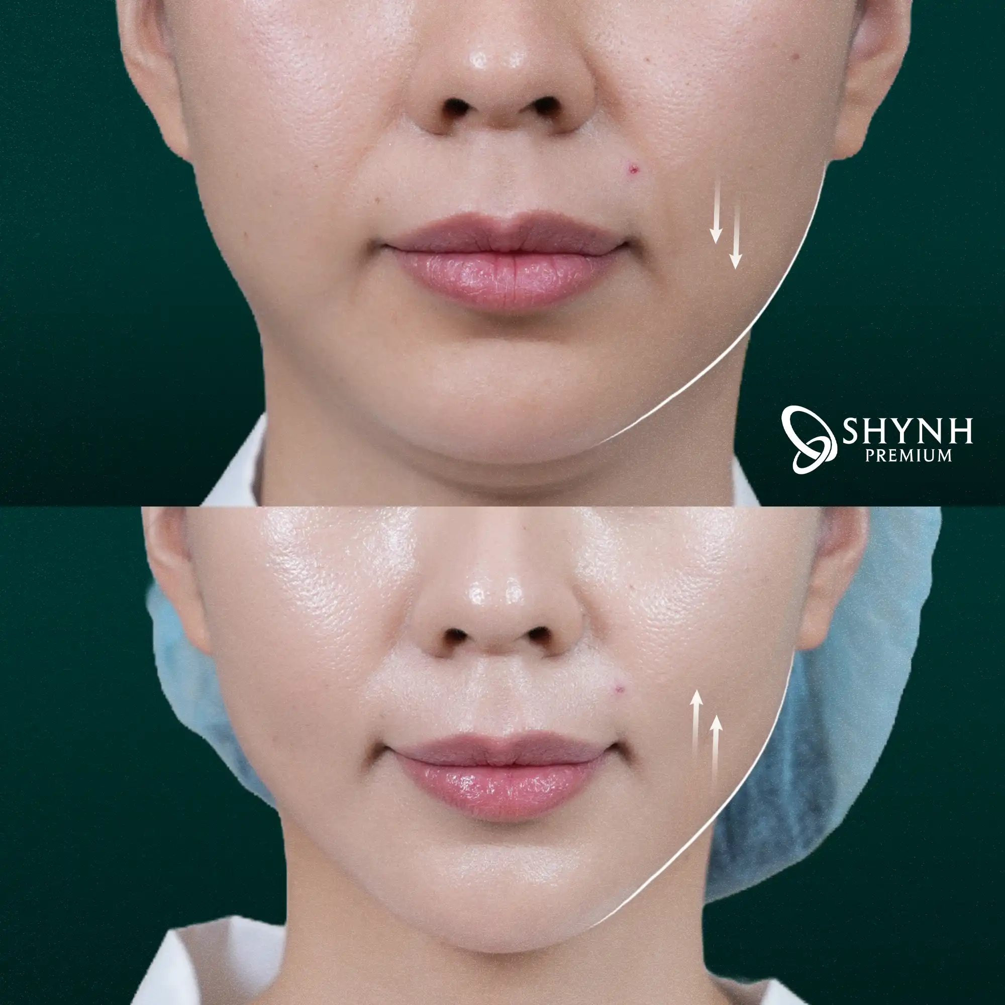 Kết quả sau liệu trình Ultherapy Prime tại Shynh Premium