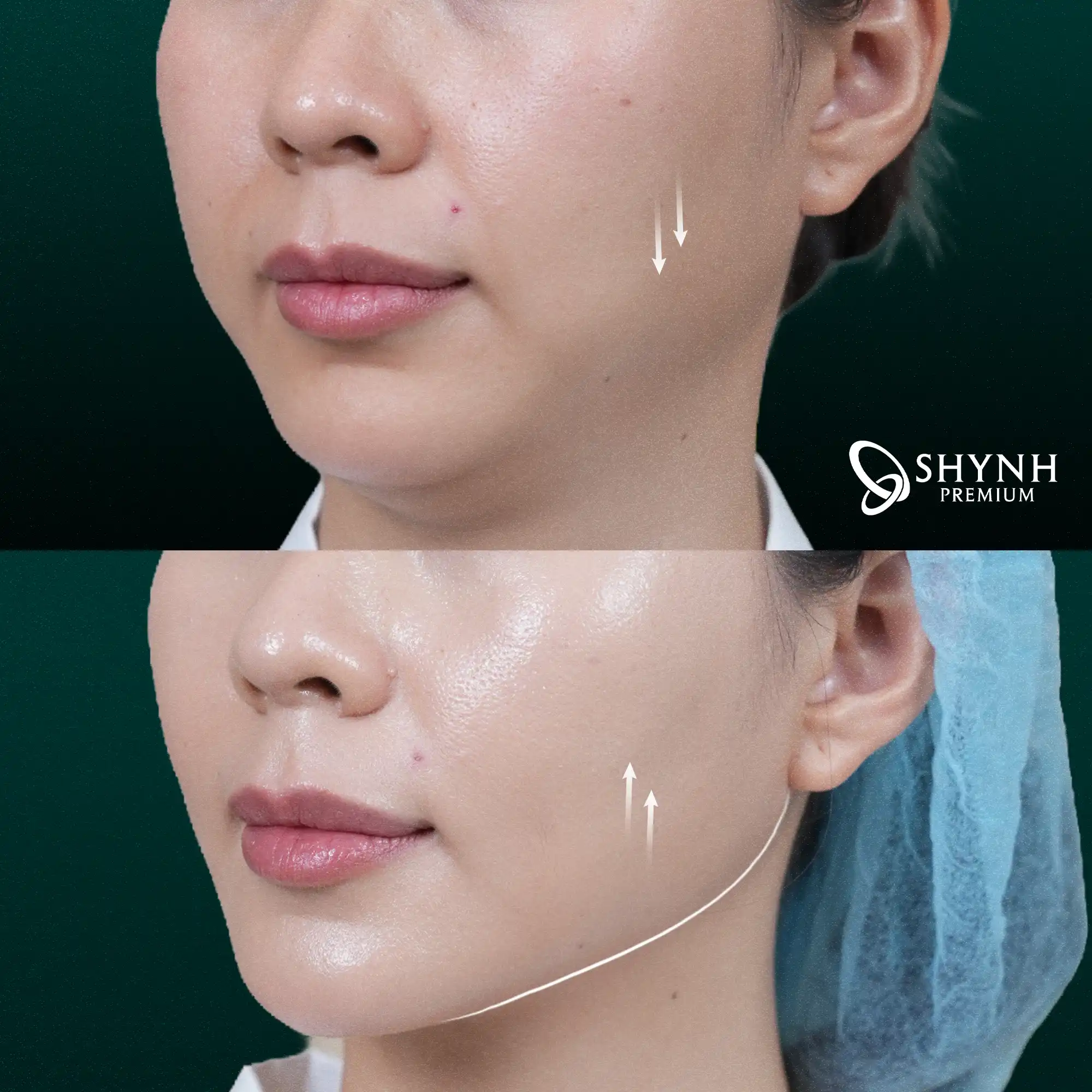 Before - After liệu trình Ultherapy Prime tại Shynh Premium