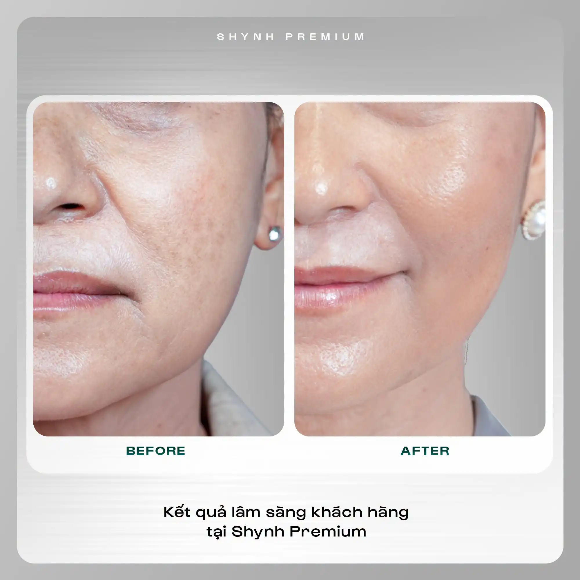 Khách hàng điều trị nám bằng công nghệ cao
