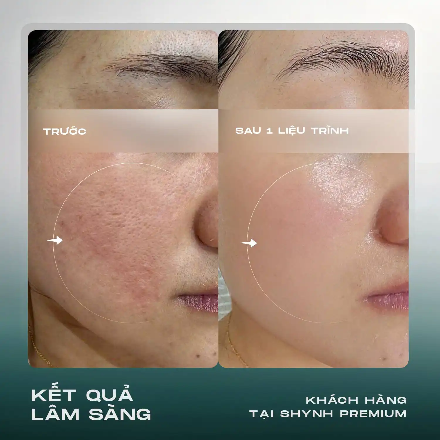 Điều trị sẹo bằng công nghệ cao tại Shynh Premium