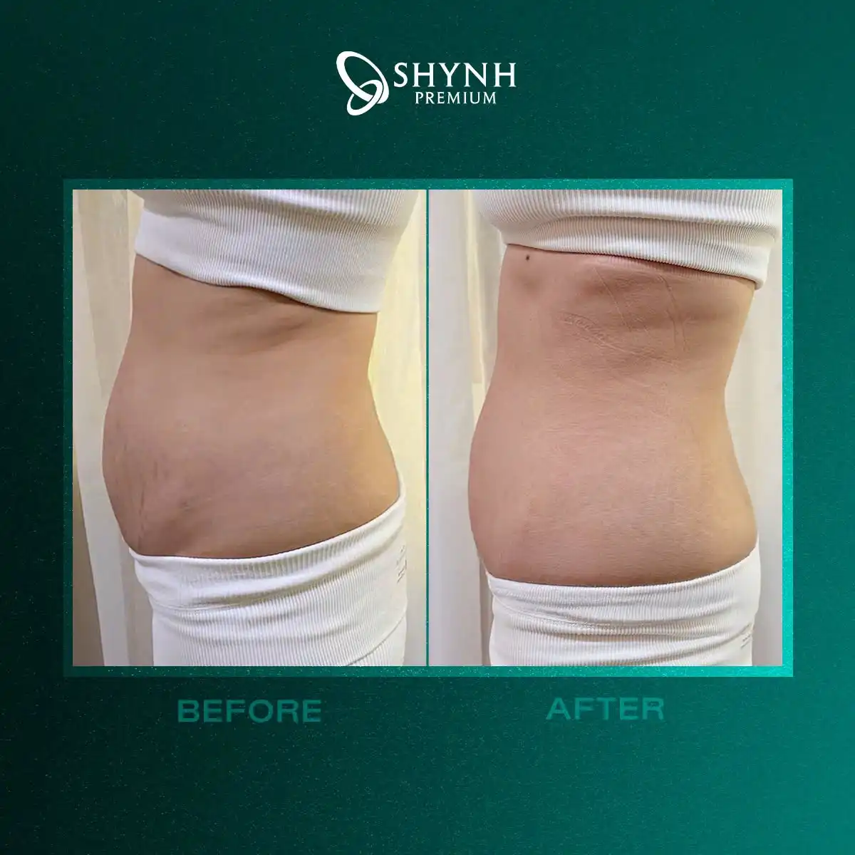 Giảm béo công nghệ cao tại Shynh Premium