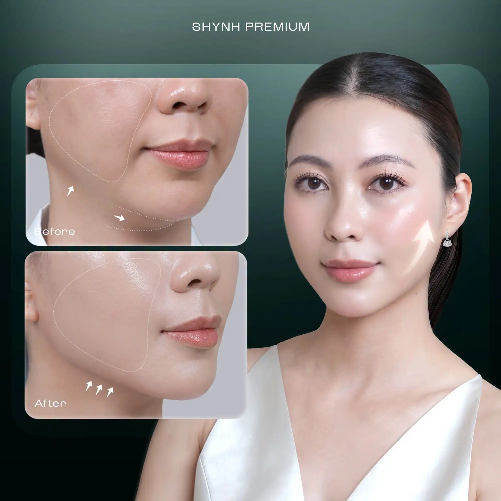 Công nghệ giúp nâng cơ - trẻ hóa da