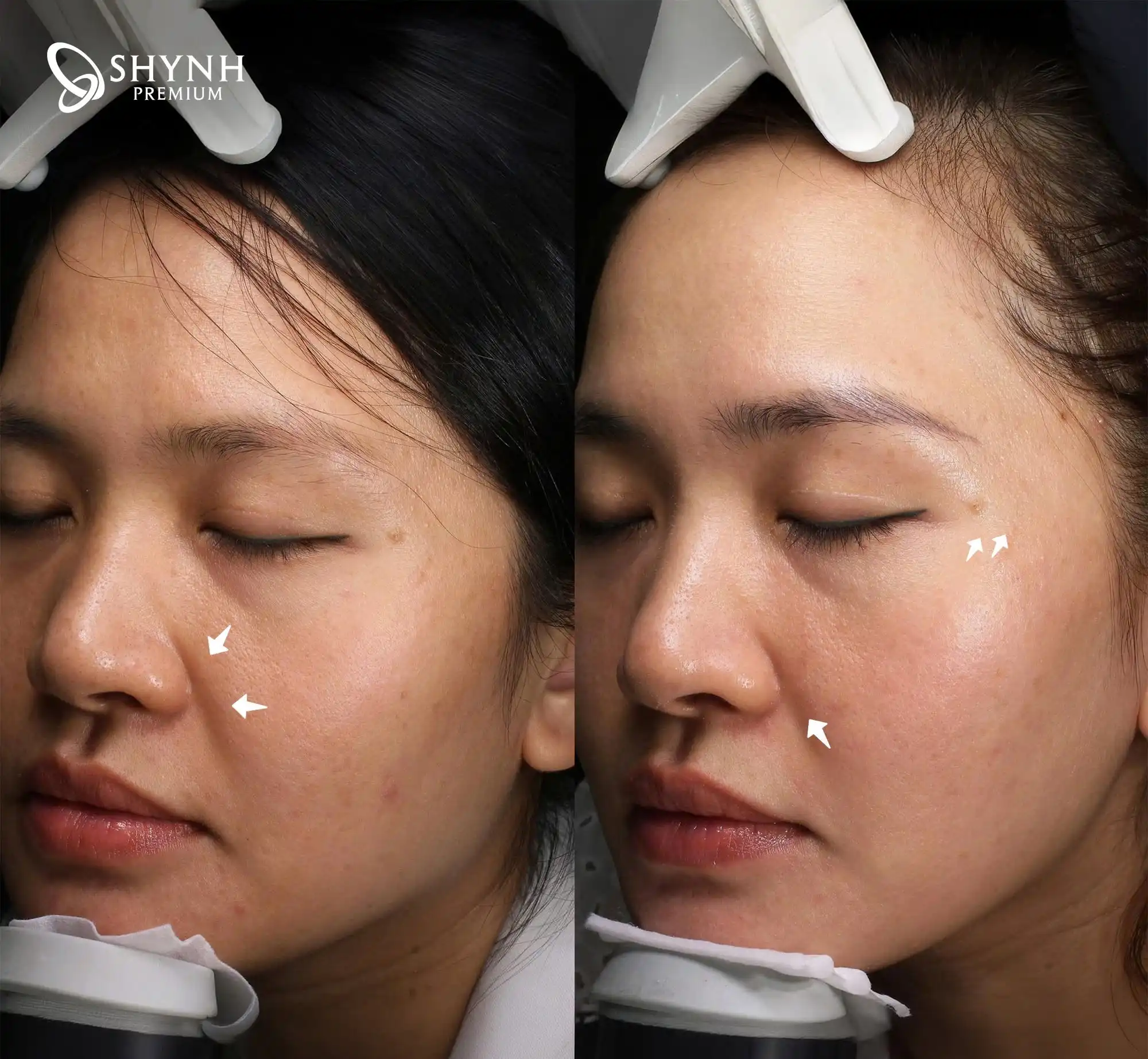 Khách hàng trải nghiệm Laser AlmaQ Trẻ hóa da đa tầng & Sẹo mụn