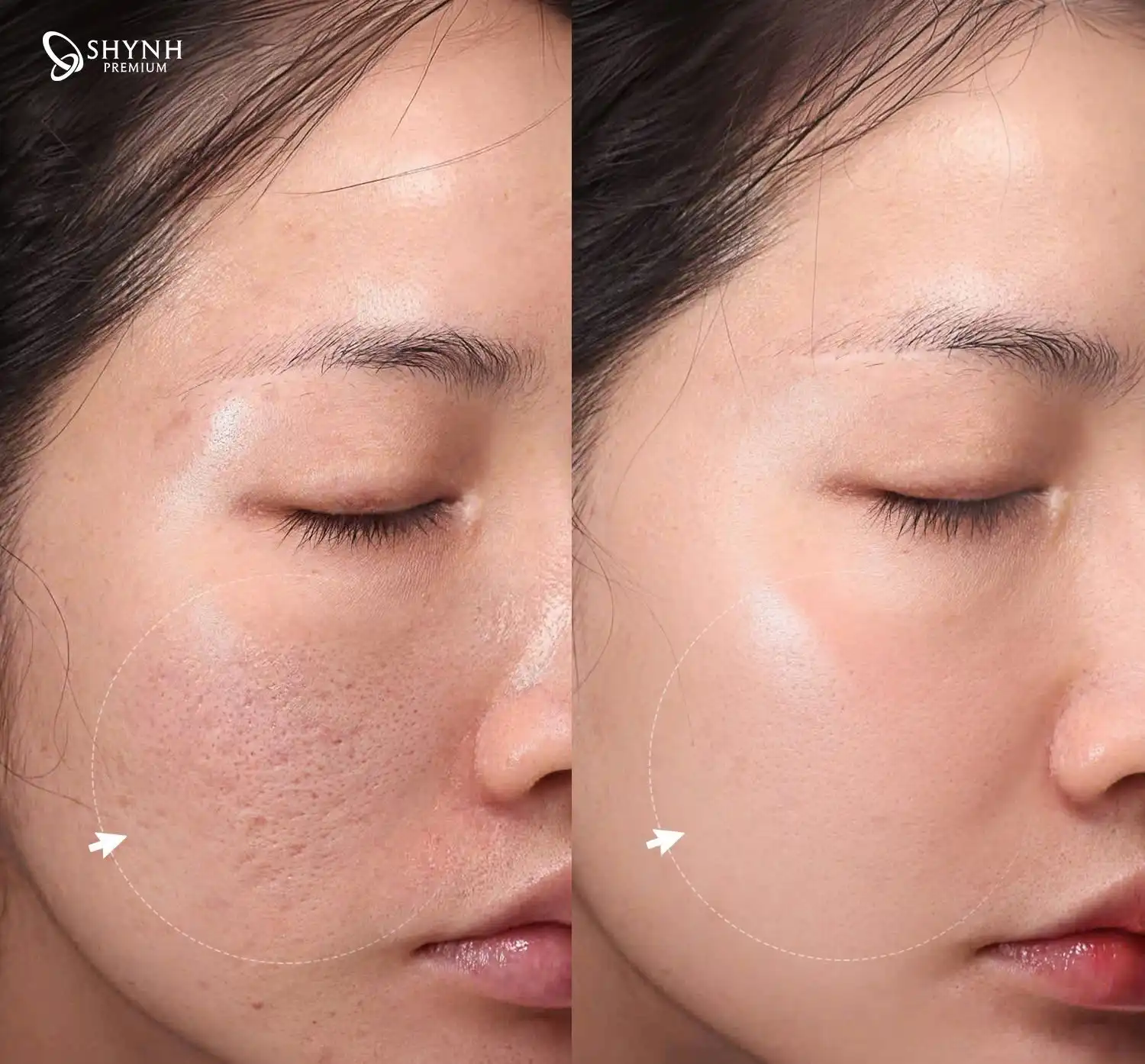 feedback khách hàng Laser AlmaQ Trẻ hóa da đa tầng & Sẹo mụn
