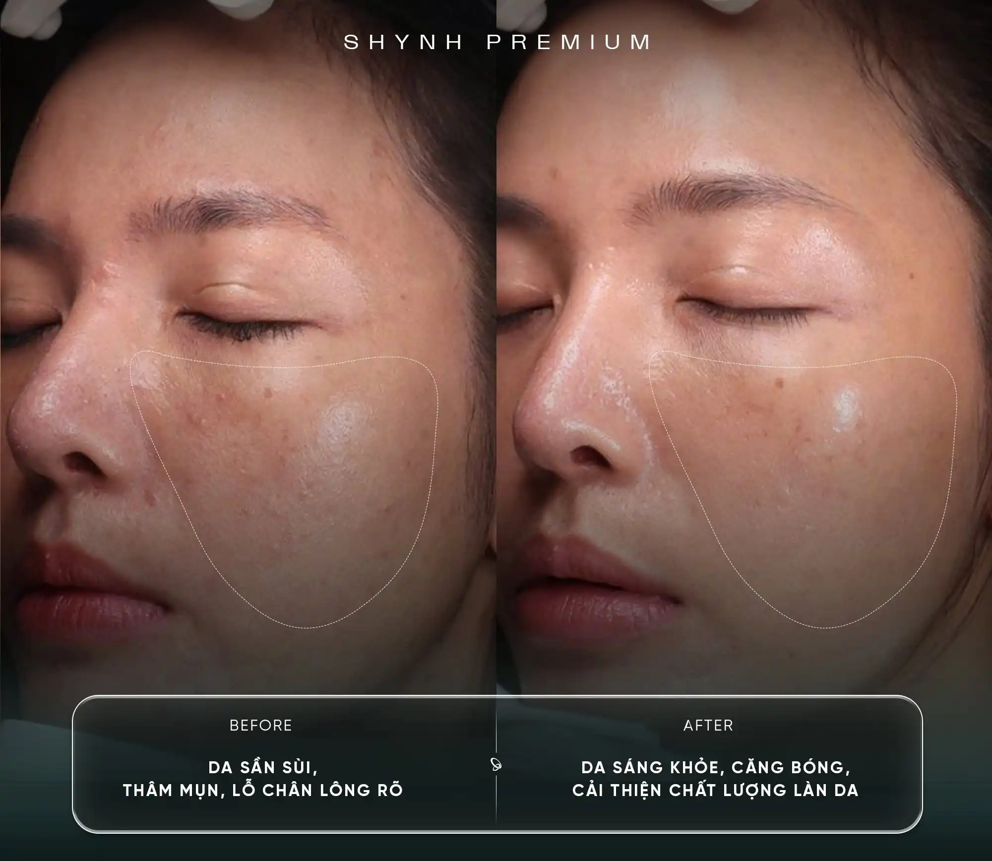 before - after Laser Alma - Q Luminous Pigment