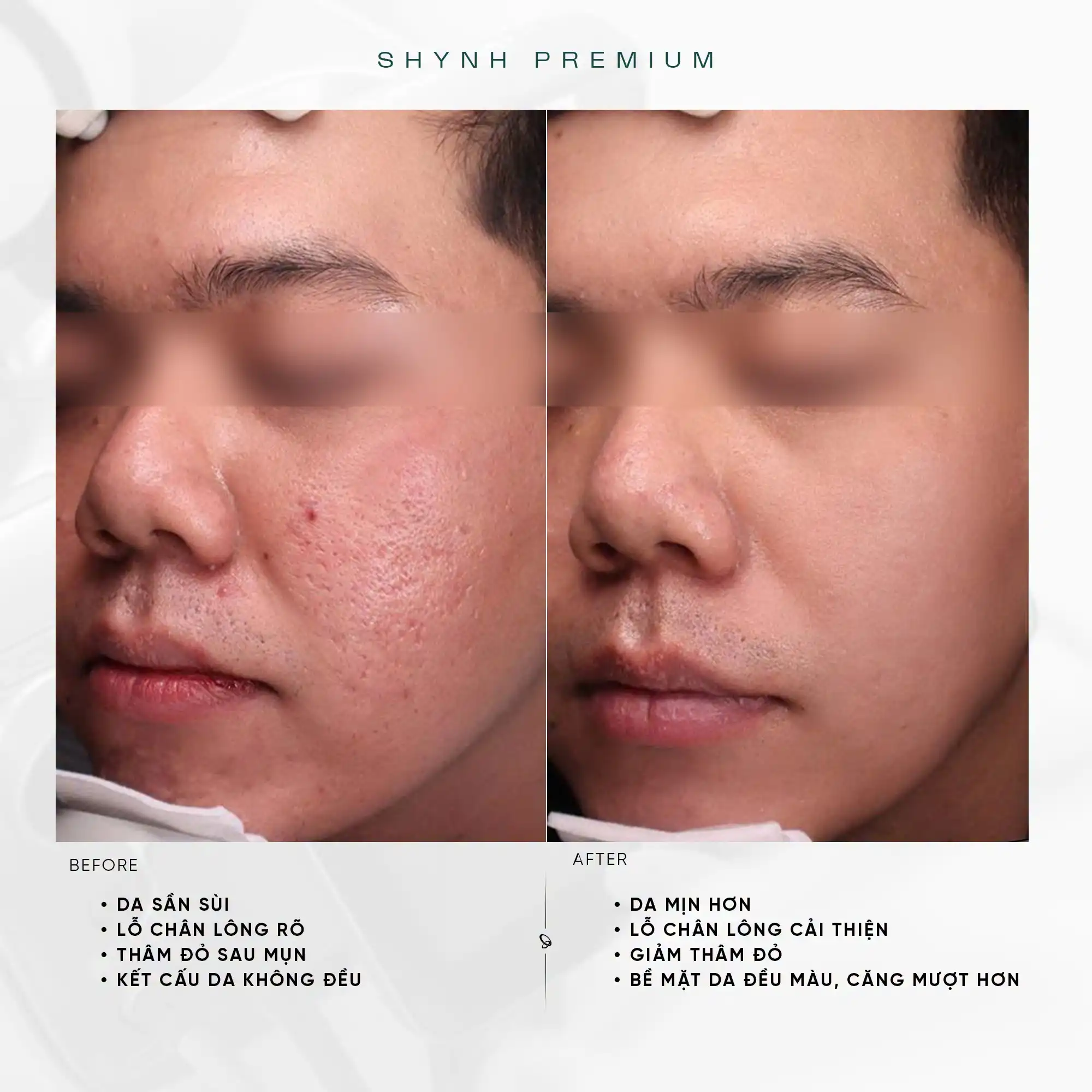 before - after Laser AlmaQ Trẻ hóa da đa tầng & Sẹo mụn